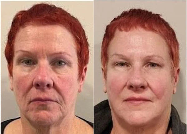 Before and after results
