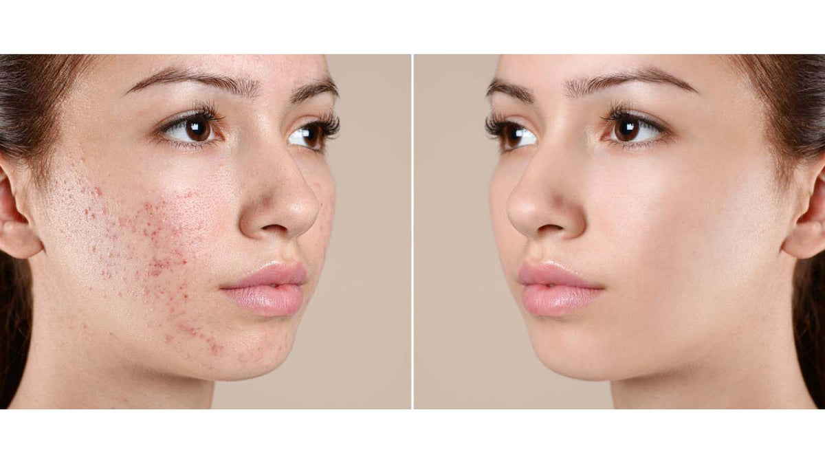 Five ways Collagen improves skin