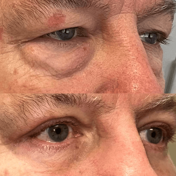 Before and after results